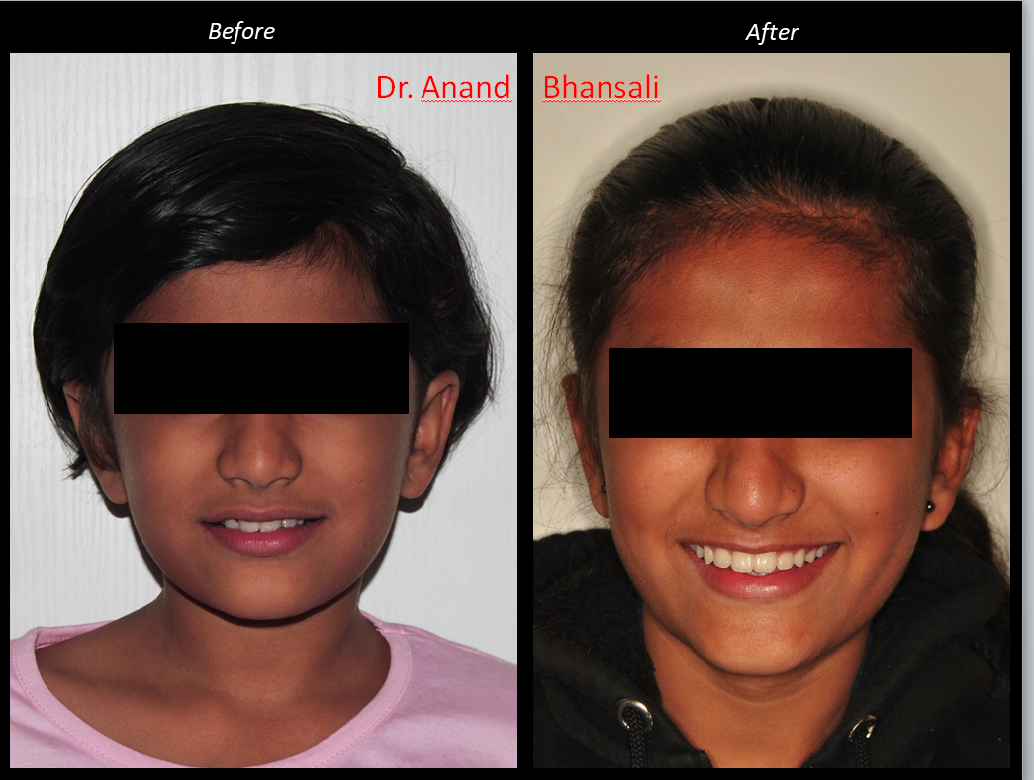 Case 10: Laser Smile Correction