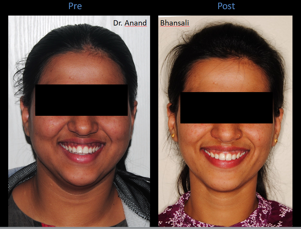 Case 4: Teeth Whitening