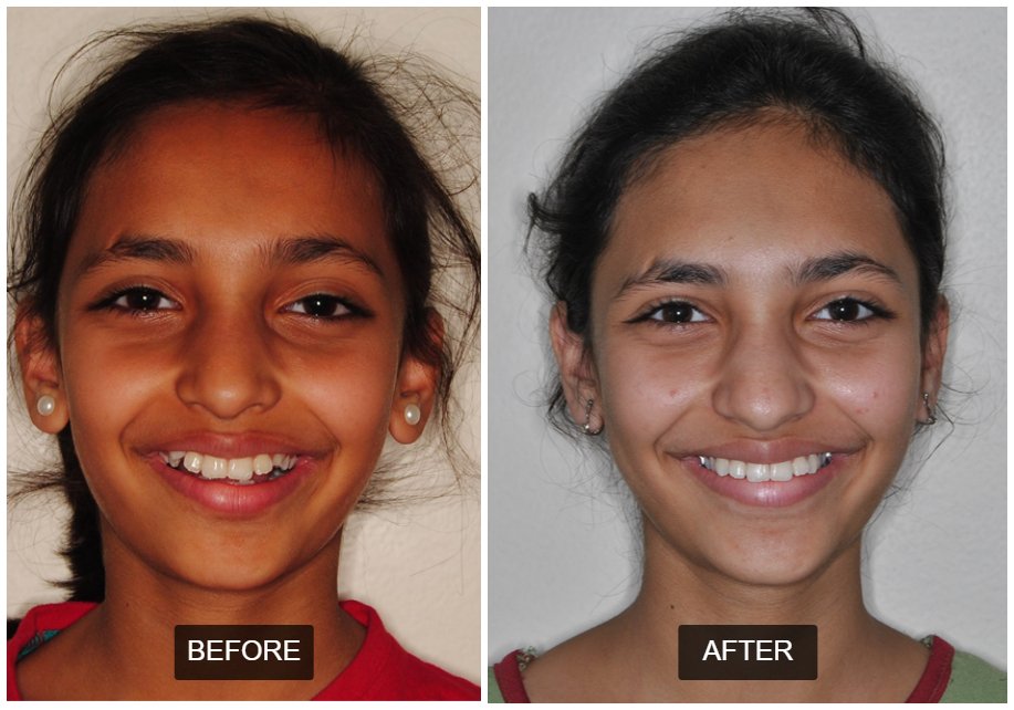 Case 6: Full Mouth Rehab